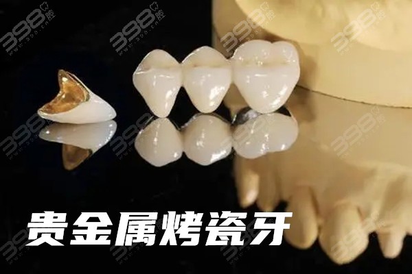 非贵金属烤瓷(非贵金属烤瓷牙多少钱一颗)