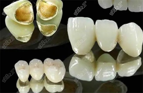 贵金属冠(贵金属冠有哪些)