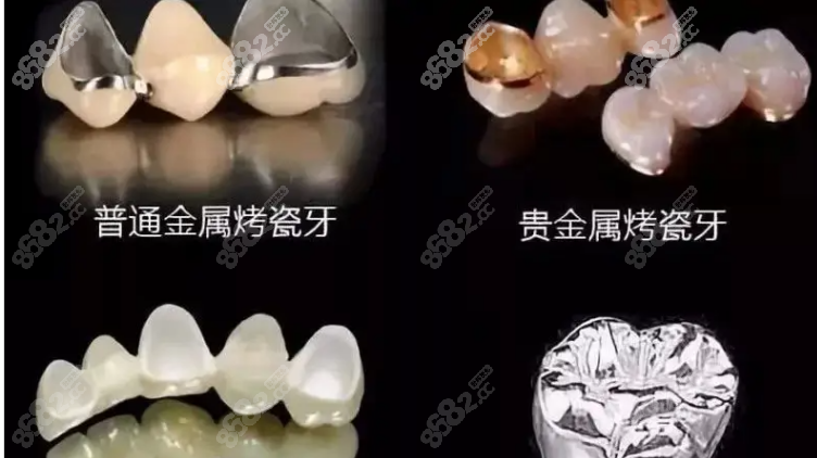 贵金属冠(贵金属冠修复病例)