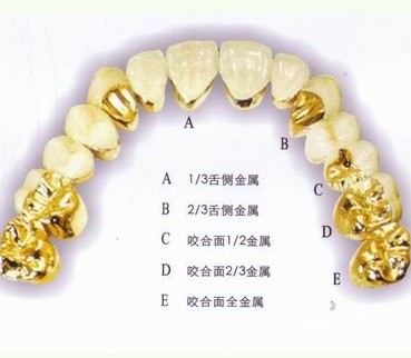 全瓷牙和贵金属哪个贵(全瓷牙比金属牙好在哪里)