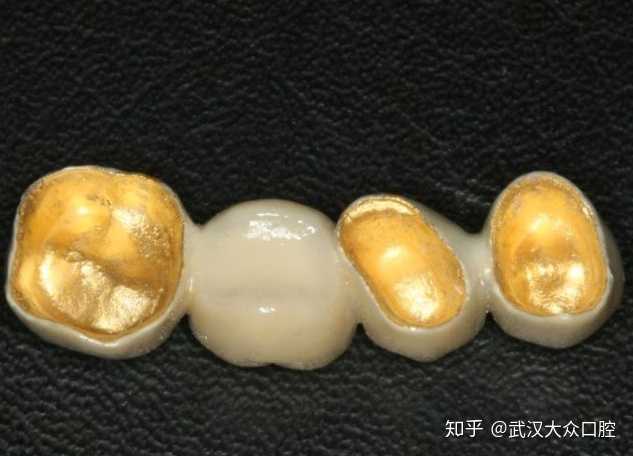 非贵金属烤瓷(非贵金属烤瓷牙和全瓷牙的区别)