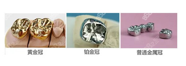 贵金属冠(贵金属冠和非贵金属冠的厚度)