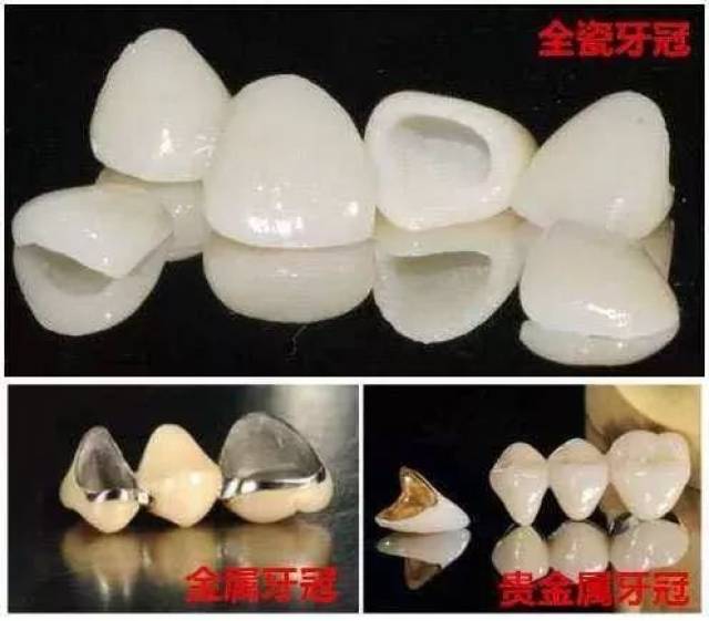 全瓷牙和贵金属哪个贵(贵的全瓷牙和便宜的有什么区别吗?)