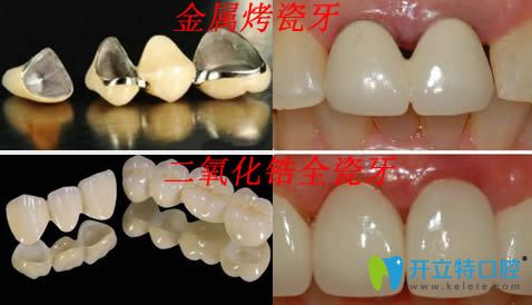 全瓷牙和贵金属哪个贵(贵的全瓷牙和便宜的有什么区别吗?)